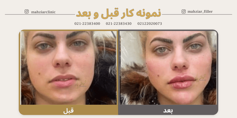 عکس قبل و بعد زاویه سازی صورت با تزریق ژل 