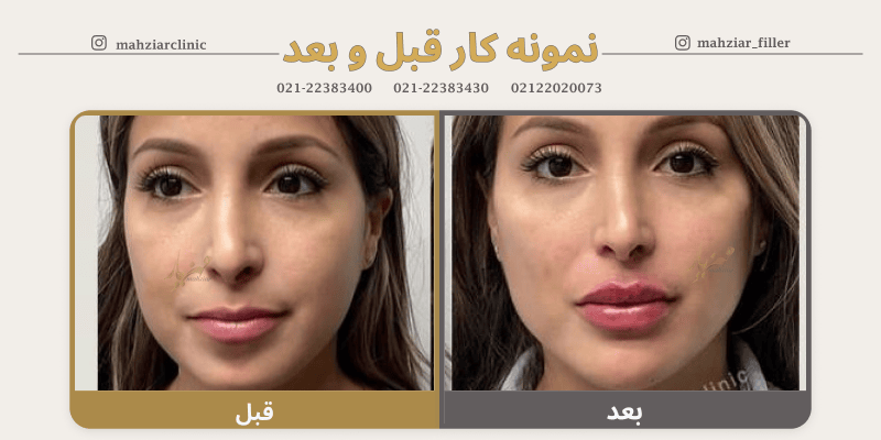 عکس قبل و بعد زاویه سازی صورت لاغر 